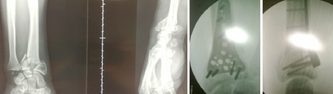 Fracture du poignet – Chirurgie de la main à Toulouse